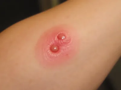 Ugryzienie pająka – Objawy, Rozpoznanie i Pierwsza Pomoc