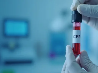 Jak wysokie CRP powinno niepokoić? Kluczowe informacje