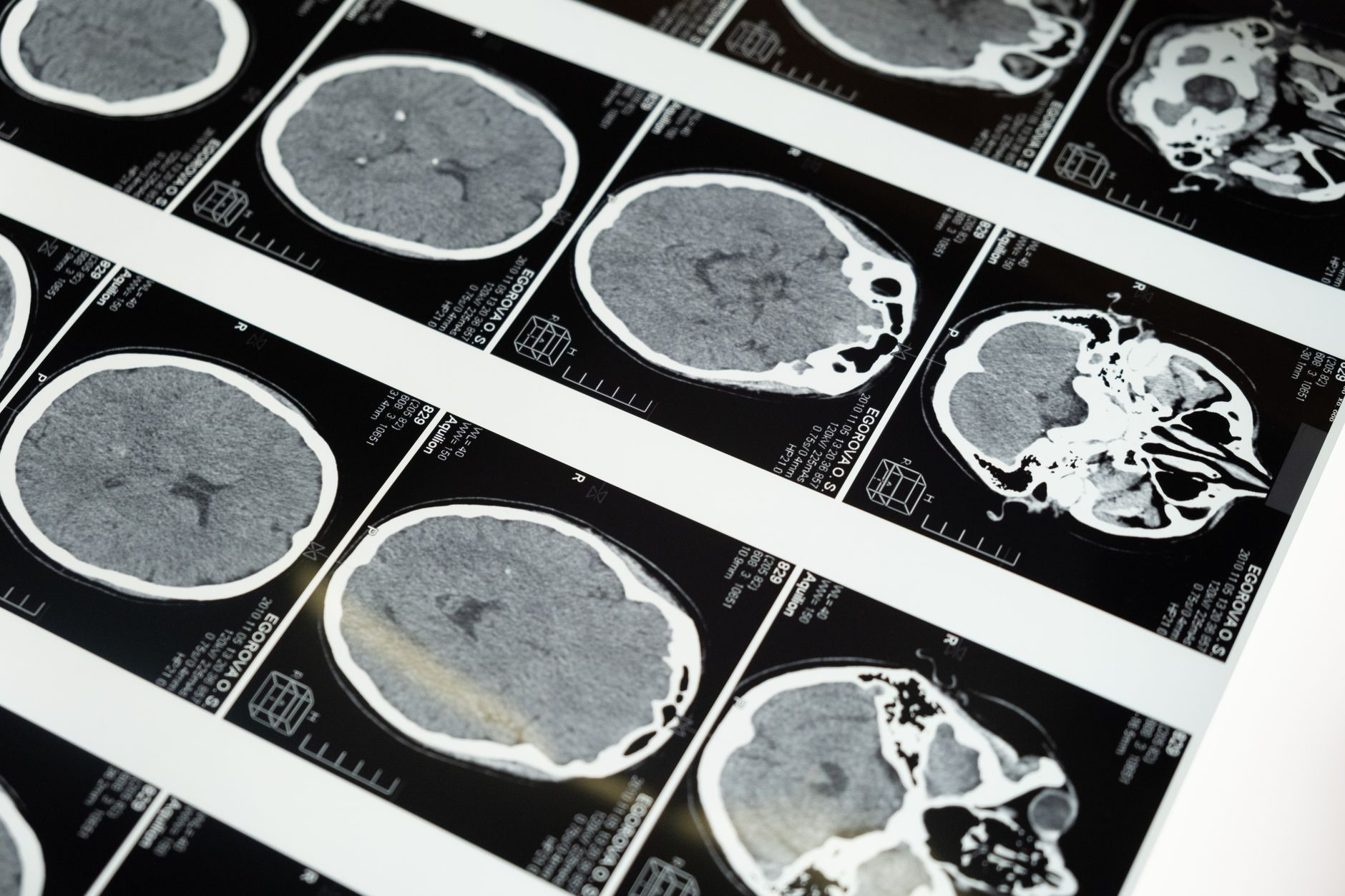 obraz rezonansu magnetycznego głowy w diagnostyce guza mózgu
